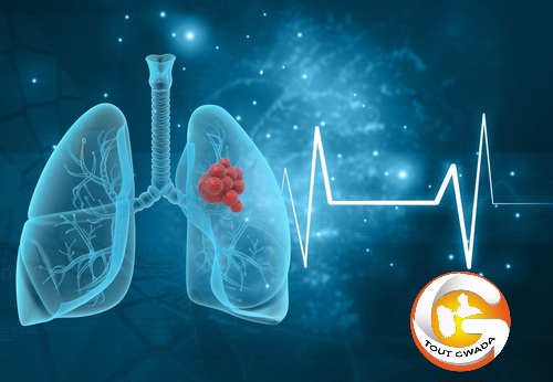 Cancer du poumon. Nouveau vaccin